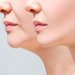 Chin Augmentation