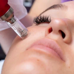 Micro-needling