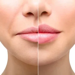 lip-augmentation